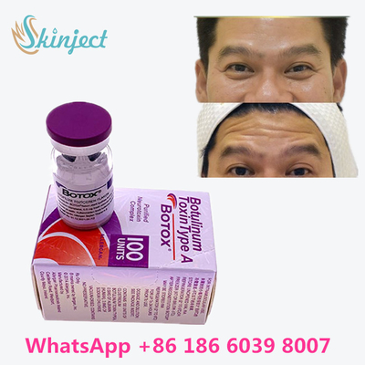 Botulinum Toxin Anti Aging Allergan  On Line خرید ضد چروک