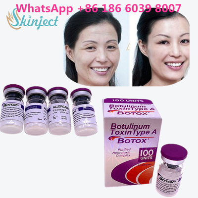 سم بوتولینوم بوتاکس رفع چین و چروک 100u Allergan 100 واحد برای تزریق لیفت صورت
