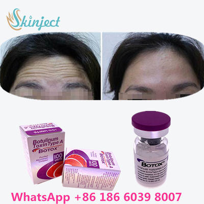 سم بوتولینوم بوتاکس رفع چین و چروک 100u Allergan 100 واحد برای تزریق لیفت صورت