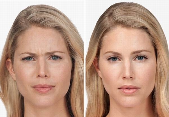 100 Iu محصولات ضد چروک کره بوتاکس سم بوتولینوم نوع A