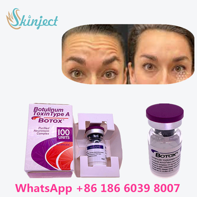 بوتاکس 100u 100% سم بوتولینوم اورجینال برای رفع چین و چروک
