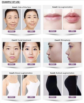 1.1 میلی لیتر Revolax Deep Hyaluronic Dermal Filler برای صورت