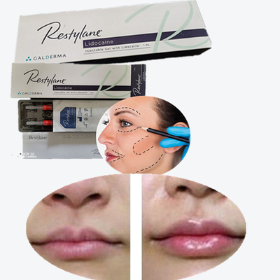 2*1ml/ Box Medical Sodium Hyaluronate Gel Filler برای لب ها