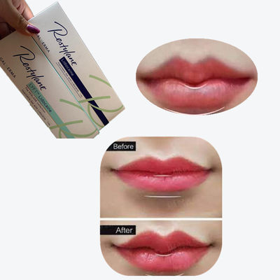 2*1ml/ Box Cross Linked Dermal Filler برای افزایش لب ها