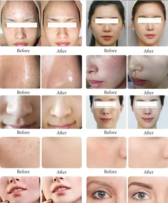 11 در 1 دستگاه فرایندهای Hydra برای پاکسازی پوست صورت Black Pearl