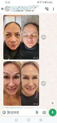 Dysport زیبایی 500 واحد Botulinum Toxin 500 IU پودر برای تزریق