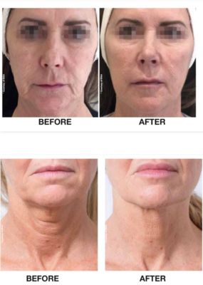 Profhilo treatments Dermal filler
