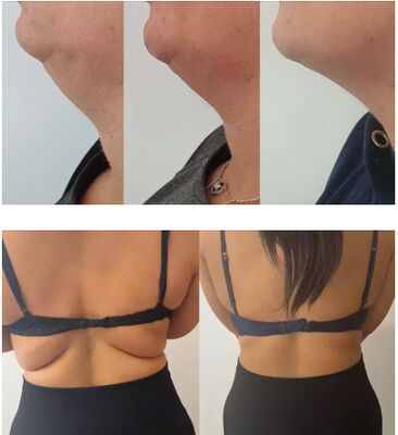 لیمو بطری تزریق محلول چربی محلول لیپولیتیک