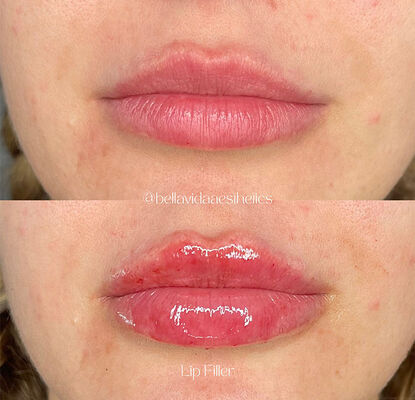 ماندگاری ۲ ساله ژل تزریقی پرکننده پوستی طراحی شده برای کاهش چین و چروک، کانتورینگ صورت و احیای پوست