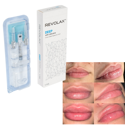 Revolax اسید هیالورونیک پرکننده پوستی طبیعی لبه های پر از چربی افزایش حجم صورت
