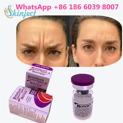 توکسین بوتولینوم بوتاکس لوازم آرایشی 100 واحد آلرژن OnabotulinumtoxinA برای چین و چروک صورت