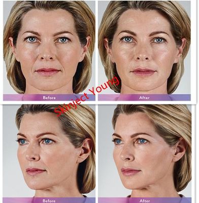 ژول پرکننده ژول تزریقی Juvederm Voluma 2x1ml اسید هیالورونیک