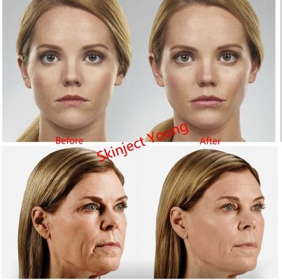 ژول پرکننده ژول تزریقی Juvederm Voluma 2x1ml اسید هیالورونیک