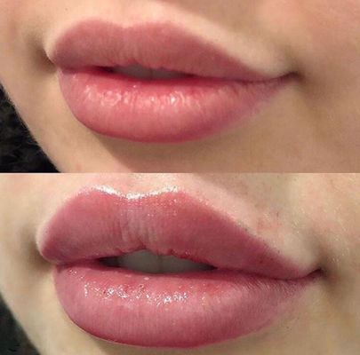 روسی لیپس Juvederm Ultra 3 با فیلر پوستی لیدوکائین متقاطع