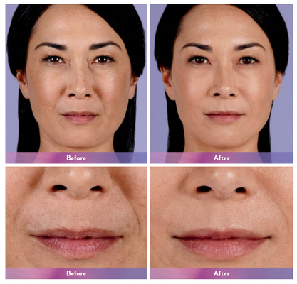 Juvederm Dermal Filler Lip Injection Ultra 4 برای بزرگ کردن لب