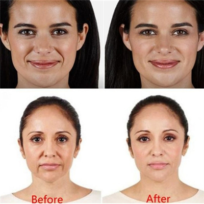 HA 2ml فیلر پوستی تزریقی پرکننده چین و چروک ژوودرم تزریقی