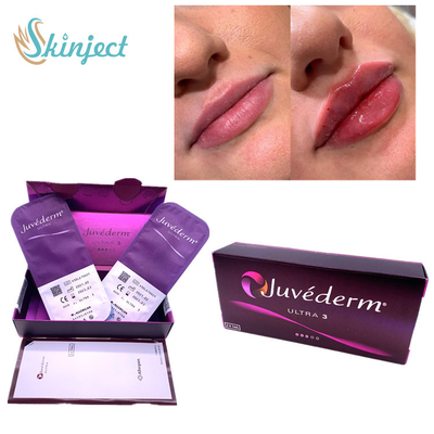 Nasolabial Folds Lips 2x1ml پوستی پرکننده هیالورونیک اسید Juvederm Ultra3