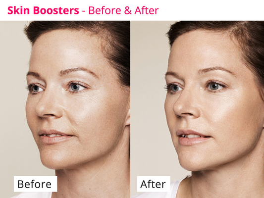 Skin Rejuvenating PDRN Skinbooster Meso Serum برای بازسازی کلاژن