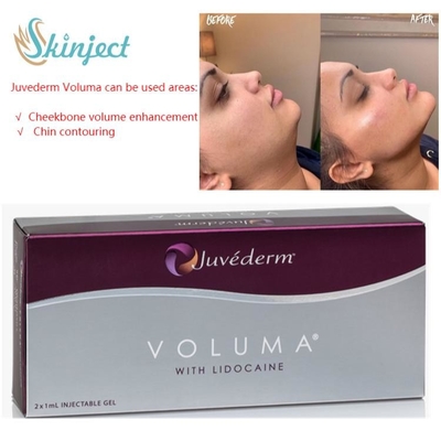 پرکننده های پوستی Juvederm Voluma 2x1ml هیالورونیک اسید برای استخوان گونه
