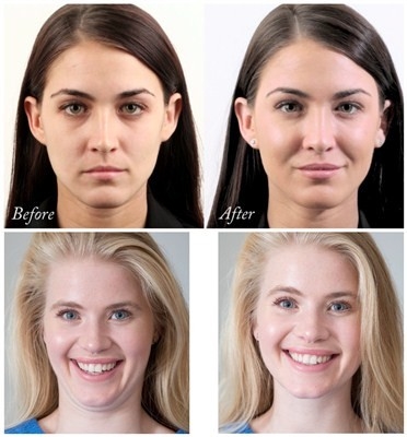 پرکننده صورت هیالورونیک اسید Juvederms Voluma برای بزرگ کردن چانه و گونه