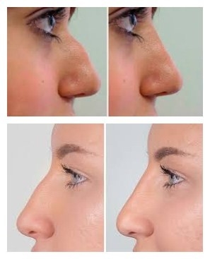 پرکننده صورت هیالورونیک اسید Juvederms Voluma برای بزرگ کردن چانه و گونه