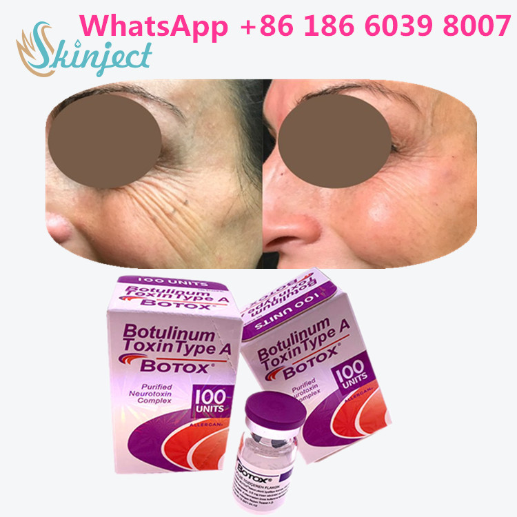 Botulinum Toxin Allergan  Type A 100 units 1 Vial / Box Packing