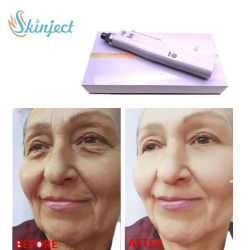 100 واحد نوع A پودر سم بوتولینوم 2-8 درجه سانتی گراد دمای نگهداری