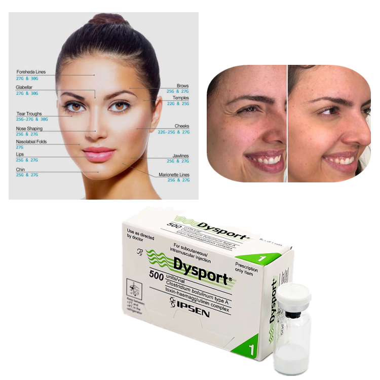 Dysport 500U Botulinum Toxin Type A برای درمان چروک ها