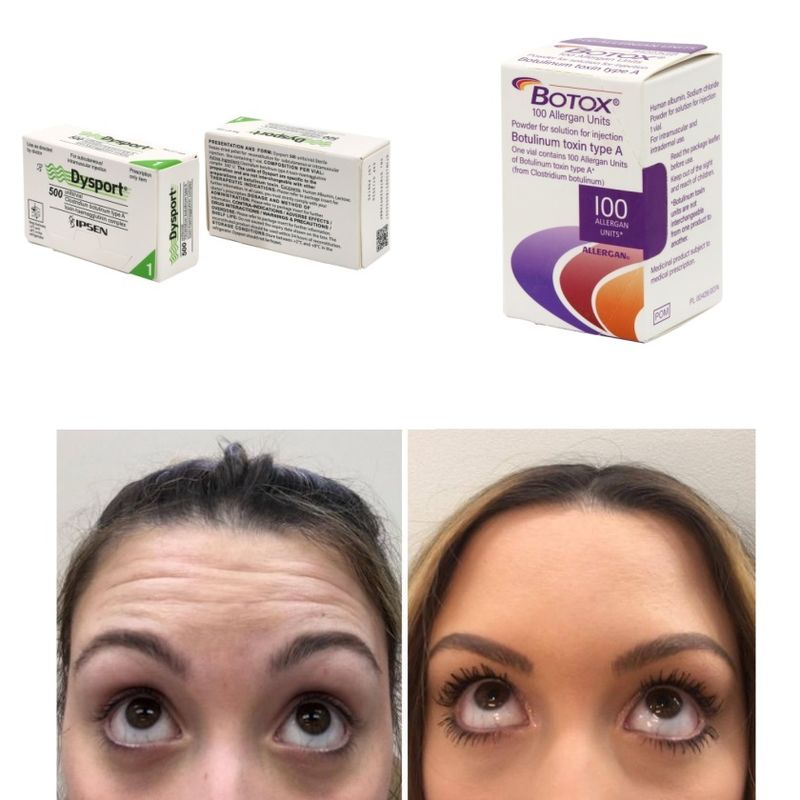 100 Units Korea Botox Botulinum Toxin for Wrinkles and Fine Lines