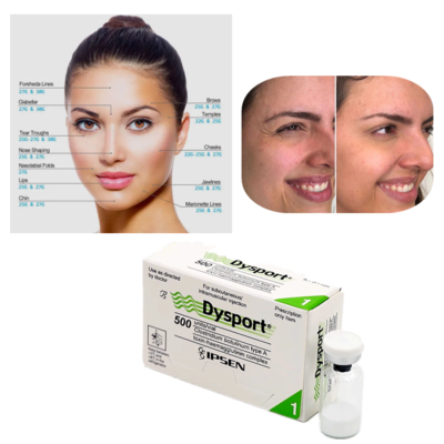 Dysport 500U Botulinum Toxin Type A برای درمان چروک ها